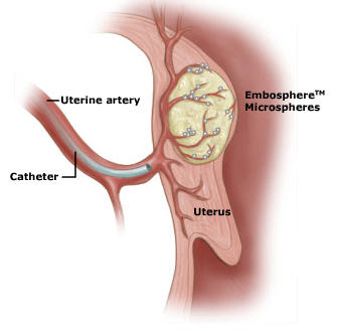 Uterine Arteries